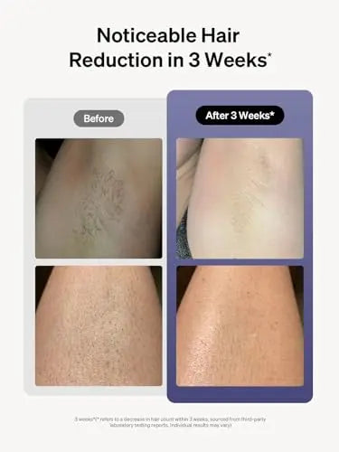 Ulike Laser Hair Removal for Women and Men, Air 3 IPL Hair Removal with Sapphire Ice-Cooling System Ulike Au supplements