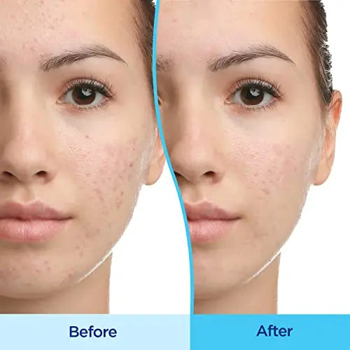 Differin Acne Treatment Gel, 30 Day Supply, Retinoid Treatment for Face Differin Au supplements