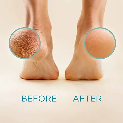 Lee Beauty Professional Callus Remover for Feet - 8 Oz, Original, Powerful Lee Beauty Professional Au supplements