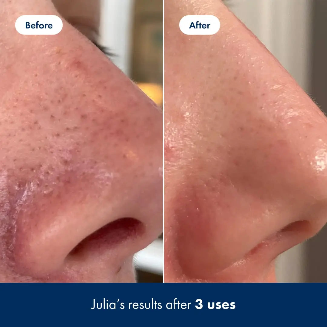 Hero Cosmetics Pore Release Blackhead Clearing Solution - Exfoliating Toner Featuring BHA HERO COSMETICS Au supplements