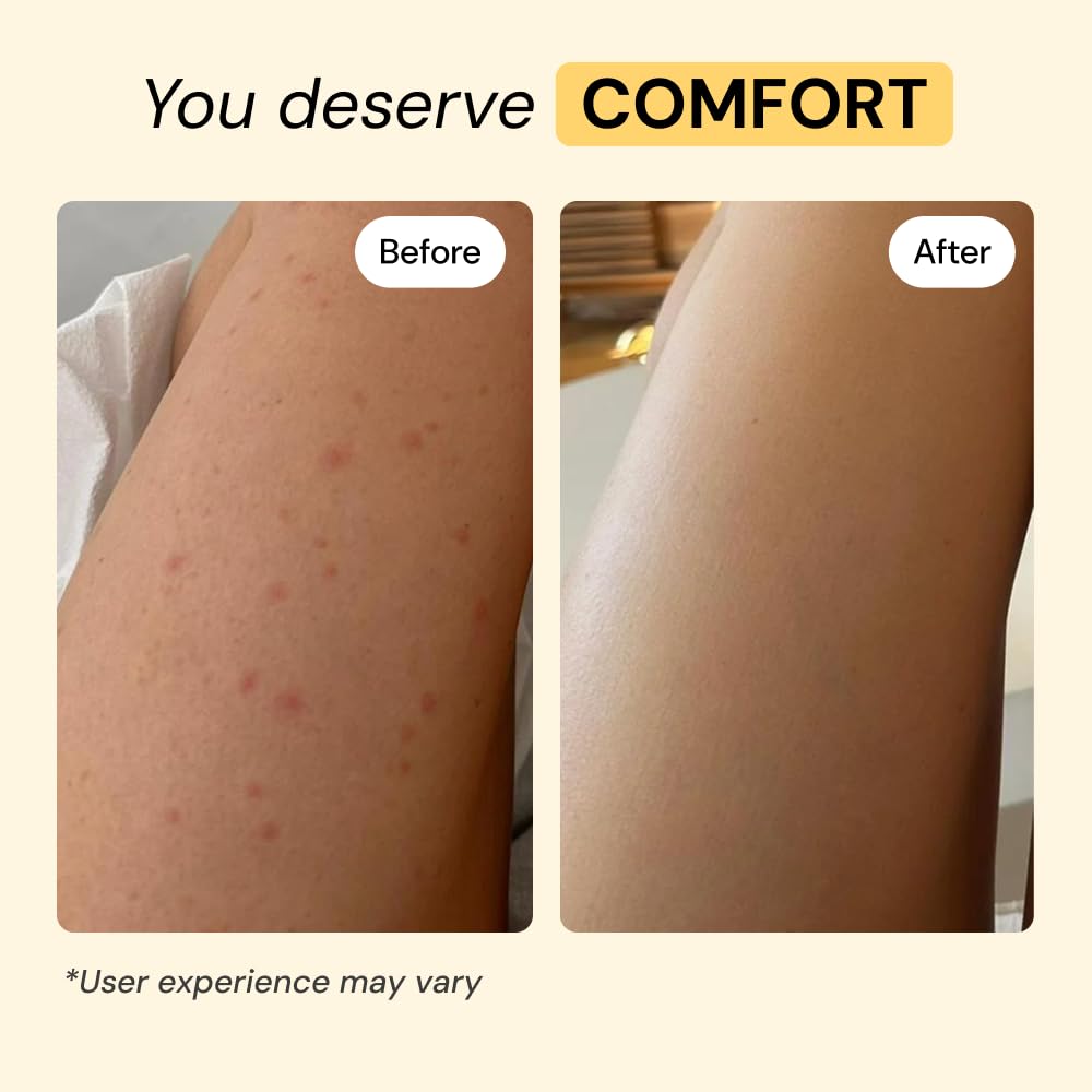 MyMagicHealer Thyme & Tea Tree Flare Care | Cystic Acne, Folliculitis, Ingrown Hair, Keratosis Pilaris, Razor Bumps, Body Bumps, Blind Pimples Multi-purpose Solution