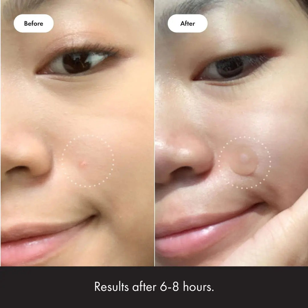 Mighty Patch Original from Hero Cosmetics - Hydrocolloid Acne Pimple Mighty Patch Au supplements