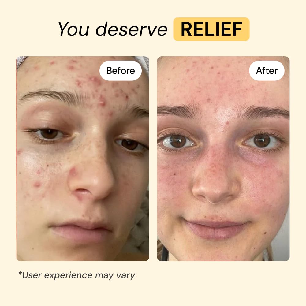 MyMagicHealer Thyme & Tea Tree Flare Care | Cystic Acne, Folliculitis, Ingrown Hair, Keratosis Pilaris, Razor Bumps, Body Bumps, Blind Pimples Multi-purpose Solution