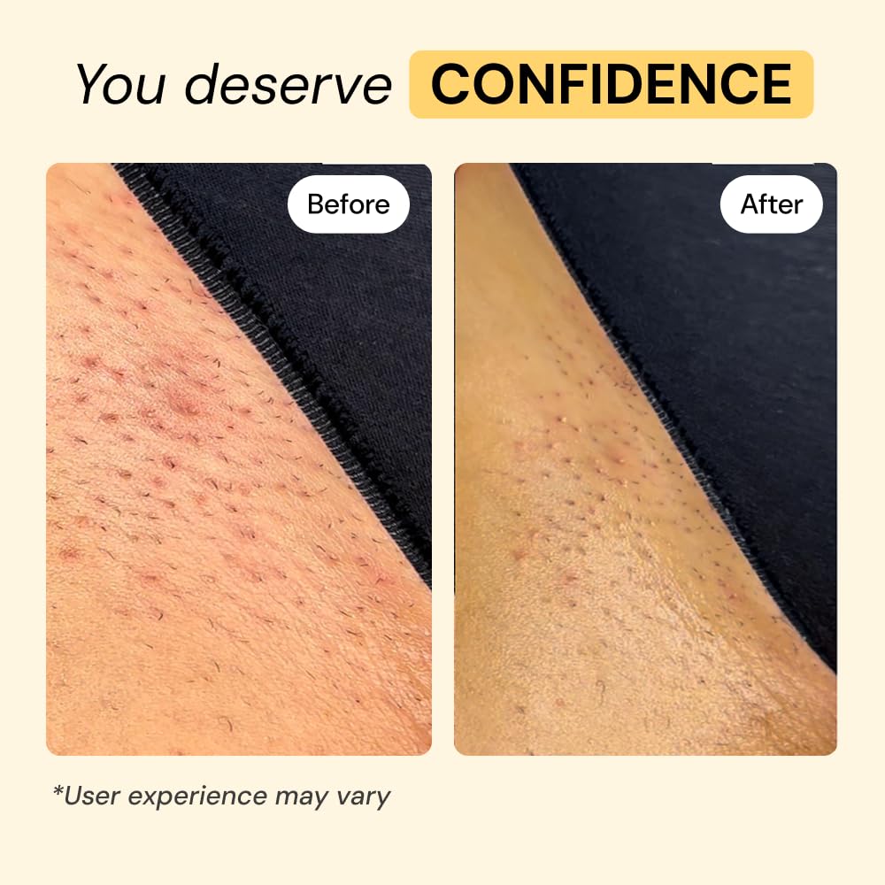 MyMagicHealer Thyme & Tea Tree Flare Care | Cystic Acne, Folliculitis, Ingrown Hair, Keratosis Pilaris, Razor Bumps, Body Bumps, Blind Pimples Multi-purpose Solution