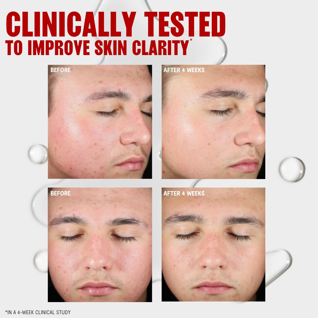 Thayers Blemish Clearing Salicylic Acid Toner, Acne Treatment Face Toner with 2% Salicylic Acid