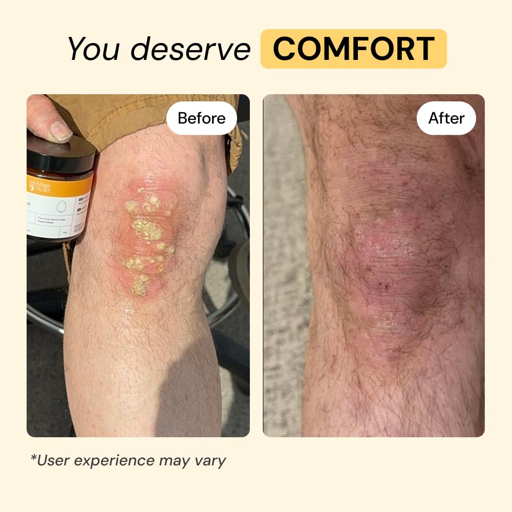 MyMagicHealer Universal Flare Care | Essential Oil Free | Baby Dermatitis, Diaper Rash, Eczema, Psoriasis, Impetigo | Wound Car