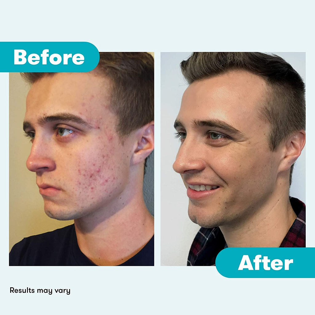 Proactiv Repair Acne Treatment Benzoyl Peroxide Spot Treatment and Repairing Serum Clear, 3 Fl Oz
