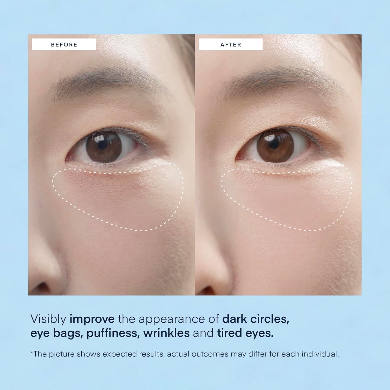 Terez & Honor Under Eye Patches for Dark Circles - 60 Korean Hydrogel Masks for Puffiness