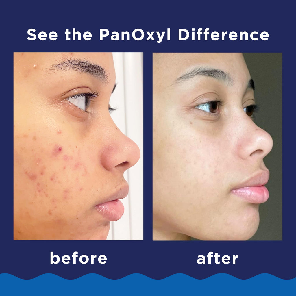 PanOxyl 10% Benzoyl Peroxide Acne Foaming Wash, Maximum Strength, Daily Acne-Fighting