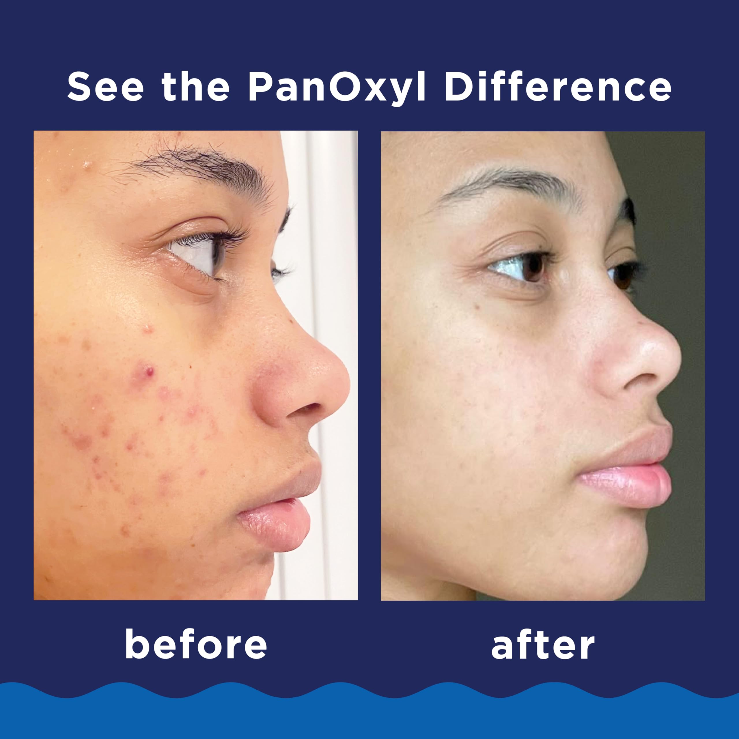 PanOxyl 10% Benzoyl Peroxide Acne Foaming Wash, Maximum Strength, Daily Acne-Fighting