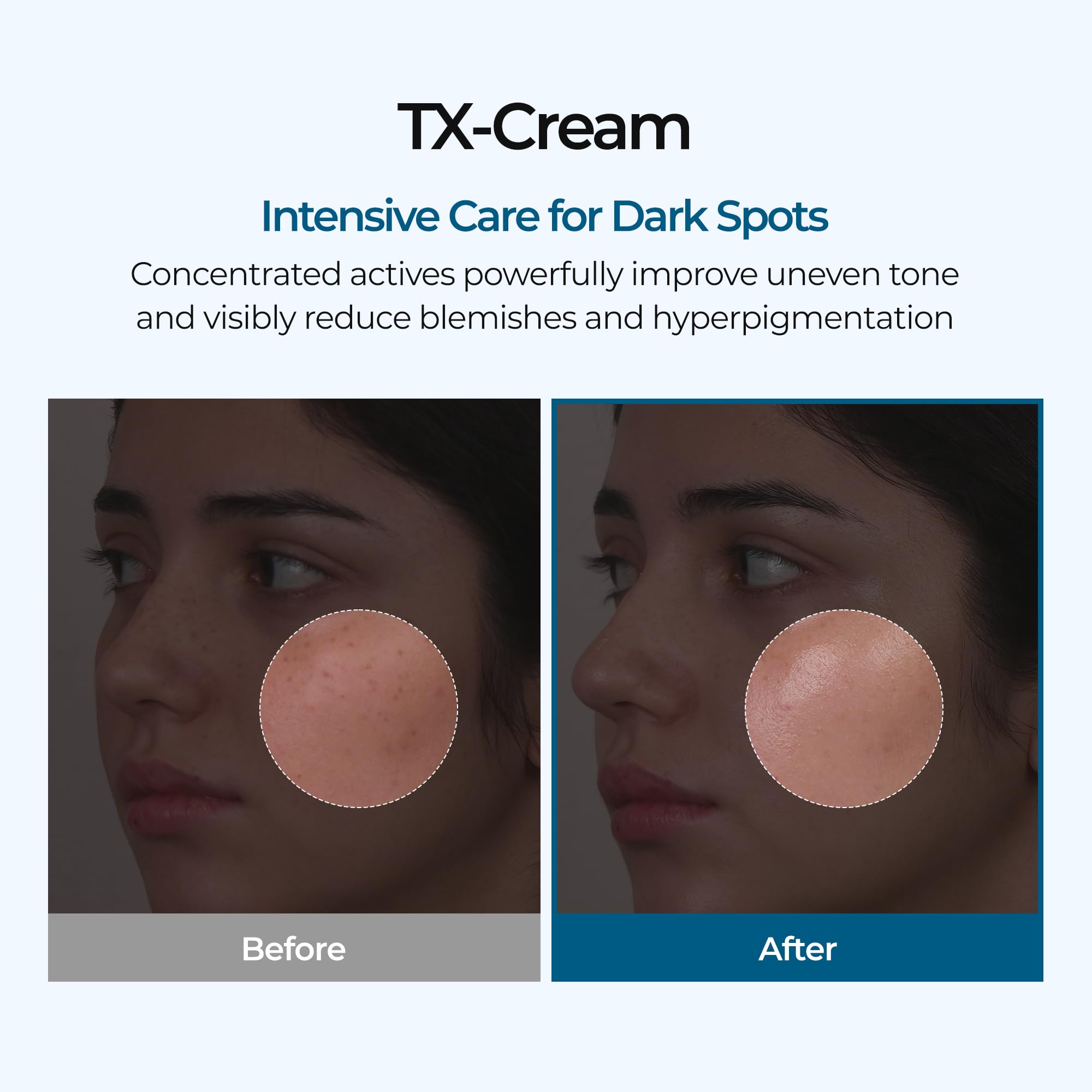 DR.Melaxin TX Tranexamic Acid CREAM | Skin freckle Cream, Blemishes, Anti-pigmetation korean skin care