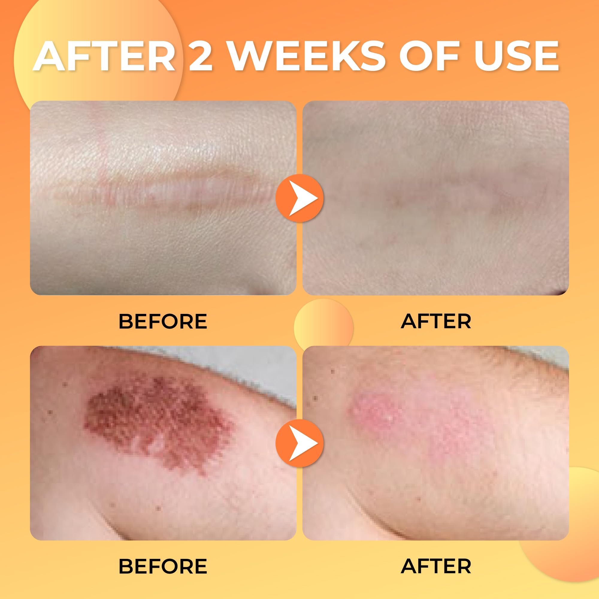 ABERA Scar Removal Cream for Women and Men - Rapid Repair of New Old Scars, Spots, Burns All Natural Treatment with Vitamin E, Alanine, Collagen (1 Box + 3 Eye Patch) ABERA Au supplements