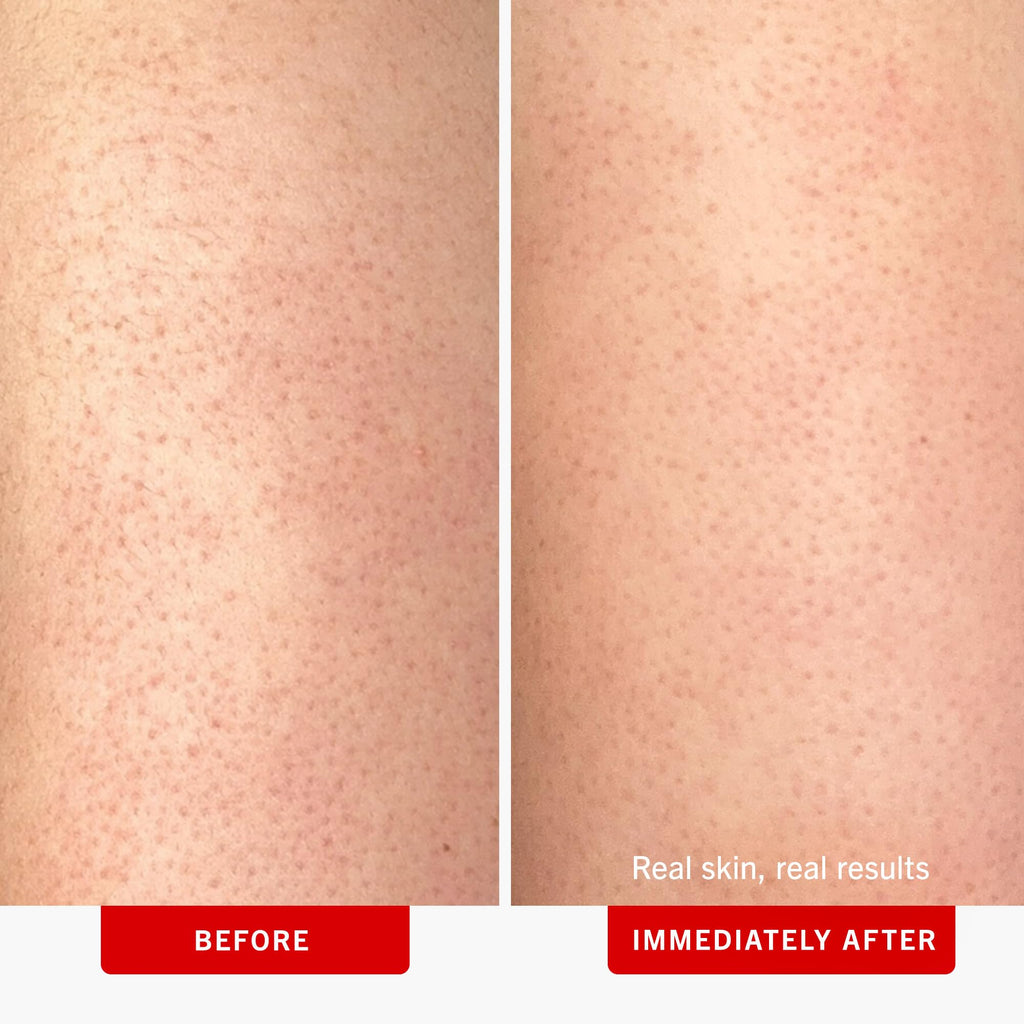 First Aid Beauty - KP Bump Eraser Body Scrub with 10% AHA, Keratosis Pilaris Exfoliator with Glycolic and Lactic acids, Helps Reduce Chicken Skin Bumps