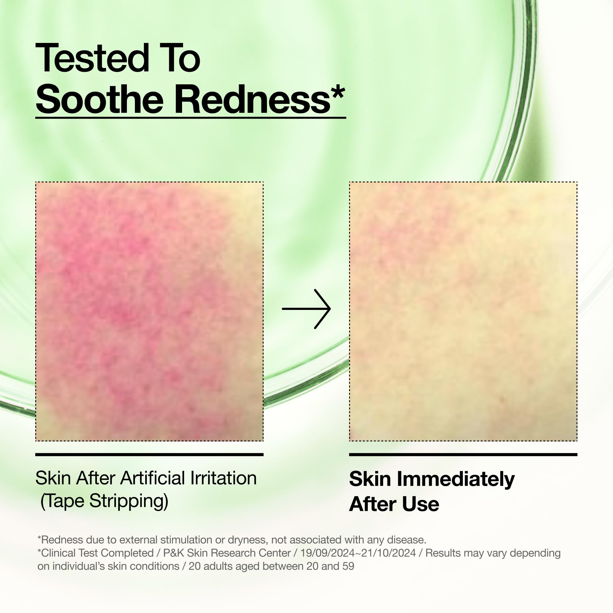 Anua Azelaic Acid 10 Hyaluron Redness Soothing Serum, Facial Serum for Blemish-Prone & Oily-Prone Skin