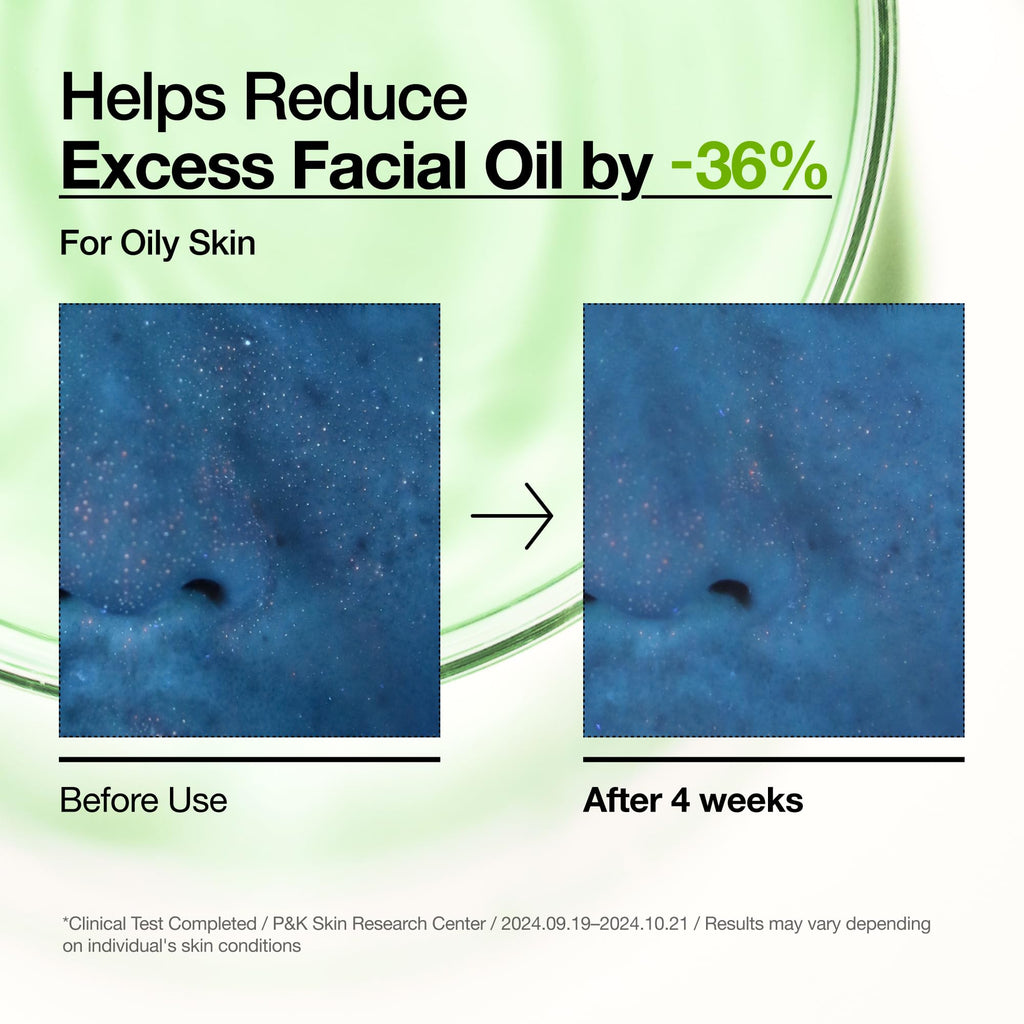 Anua Azelaic Acid 10 Hyaluron Redness Soothing Serum, Facial Serum for Blemish-Prone & Oily-Prone Skin