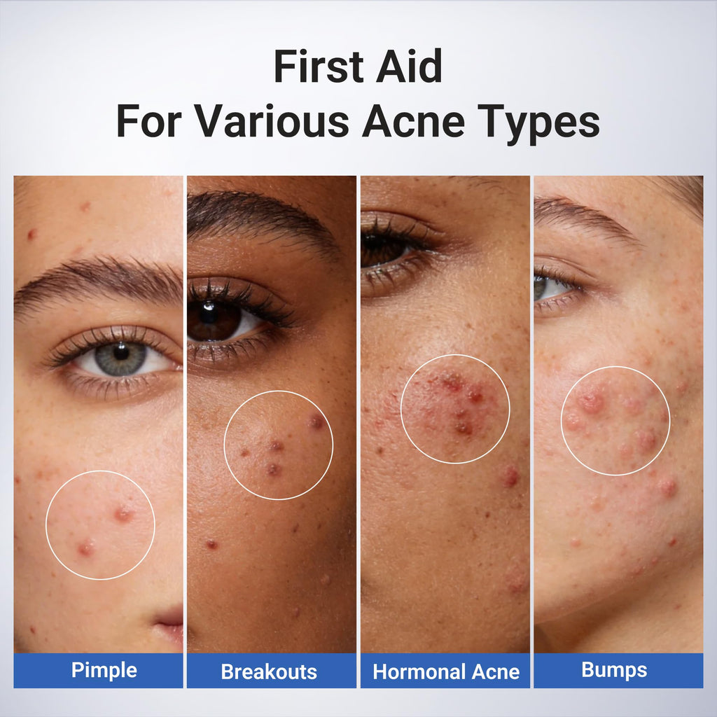 Dr.Leo 1.8% Salicylic Acid Spot Serum, Acne Treatment for Acne-Prone Sensitive Skin | Niacinamide, Fast Pimple Relief, Fades Acne Marks