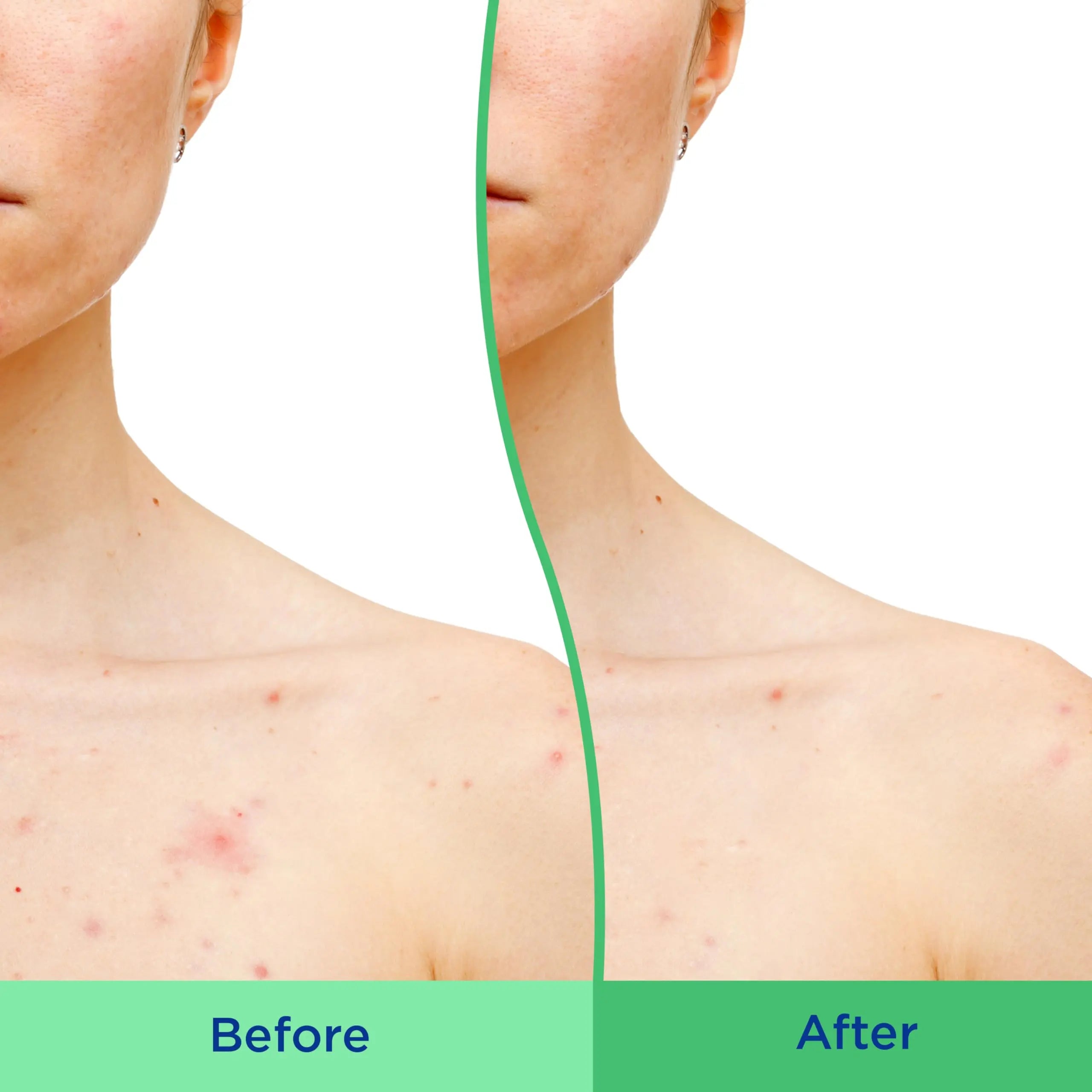 Differin Body Scrub with Salicylic Acid Acne Clearing Improves Tone and Texture Prone Skin Differin Au supplements