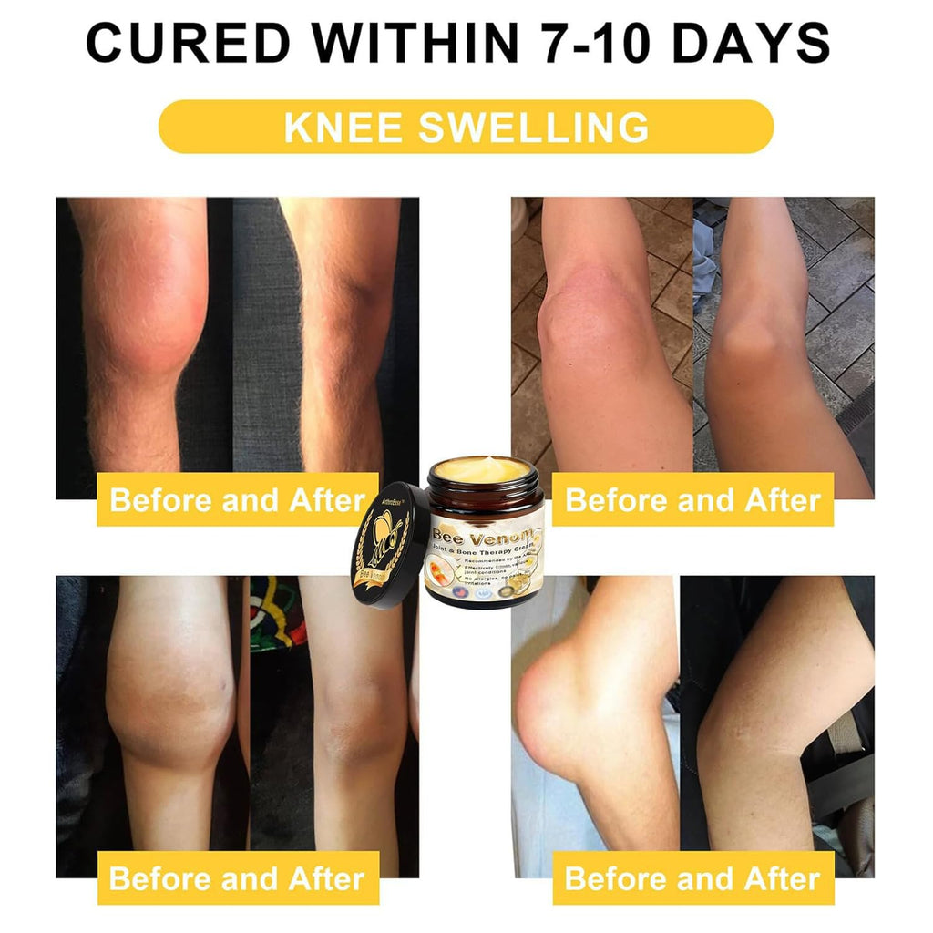 ArthroEase Bee Venom Arthritis Cream, Joint & Muscle Soothing Bee Venom Cream, Professional Bee Venom Joint Cream, Bee Venom Joint Gel - Specially for for Back, Neck, Hands, Knee (2 Bottle) Lmoy Au supplements