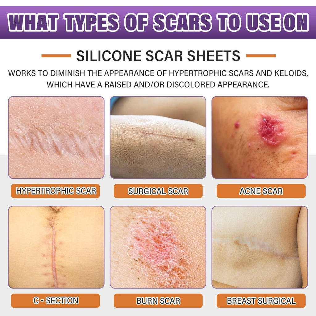 Silicone Scar Sheets,Silicone Scar Tape,Silicone Scar Removal Strips for Surgical,C-Section,Tummy Tuck,Keloid Scars