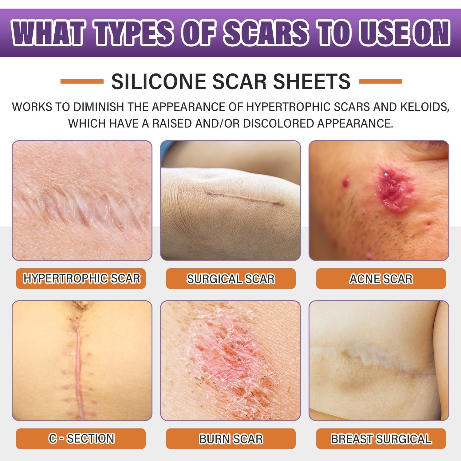 Silicone Scar Sheets,Silicone Scar Tape,Silicone Scar Removal Strips for Surgical,C-Section,Tummy Tuck,Keloid Scars