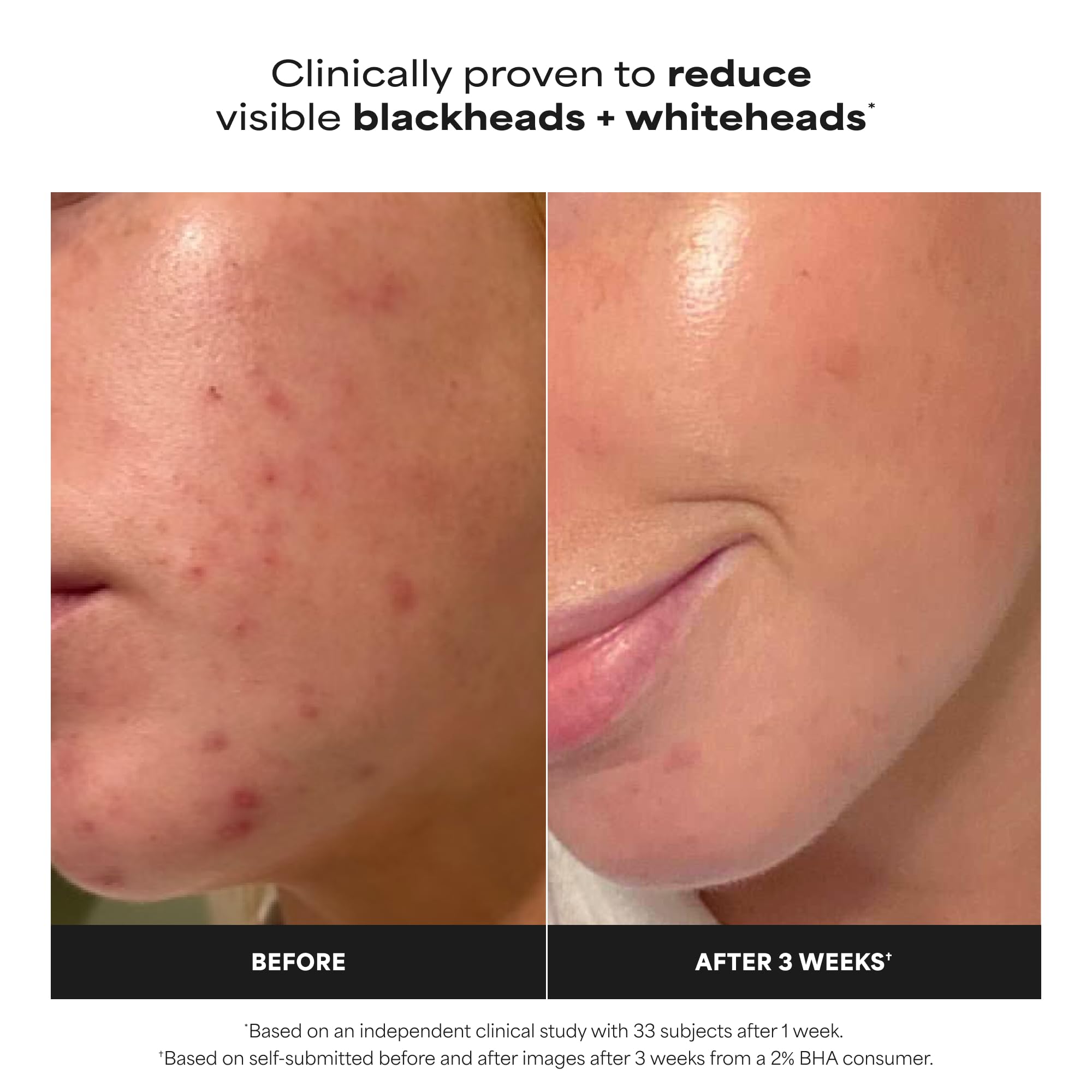 Paulas Choice--SKIN PERFECTING 2% BHA Liquid Salicylic Acid Exfoliant--Facial Exfoliant for Blackheads, Enlarged Pores, Wrinkles & Fine Lines, 4 oz Bottle Paula's Choice Au supplements