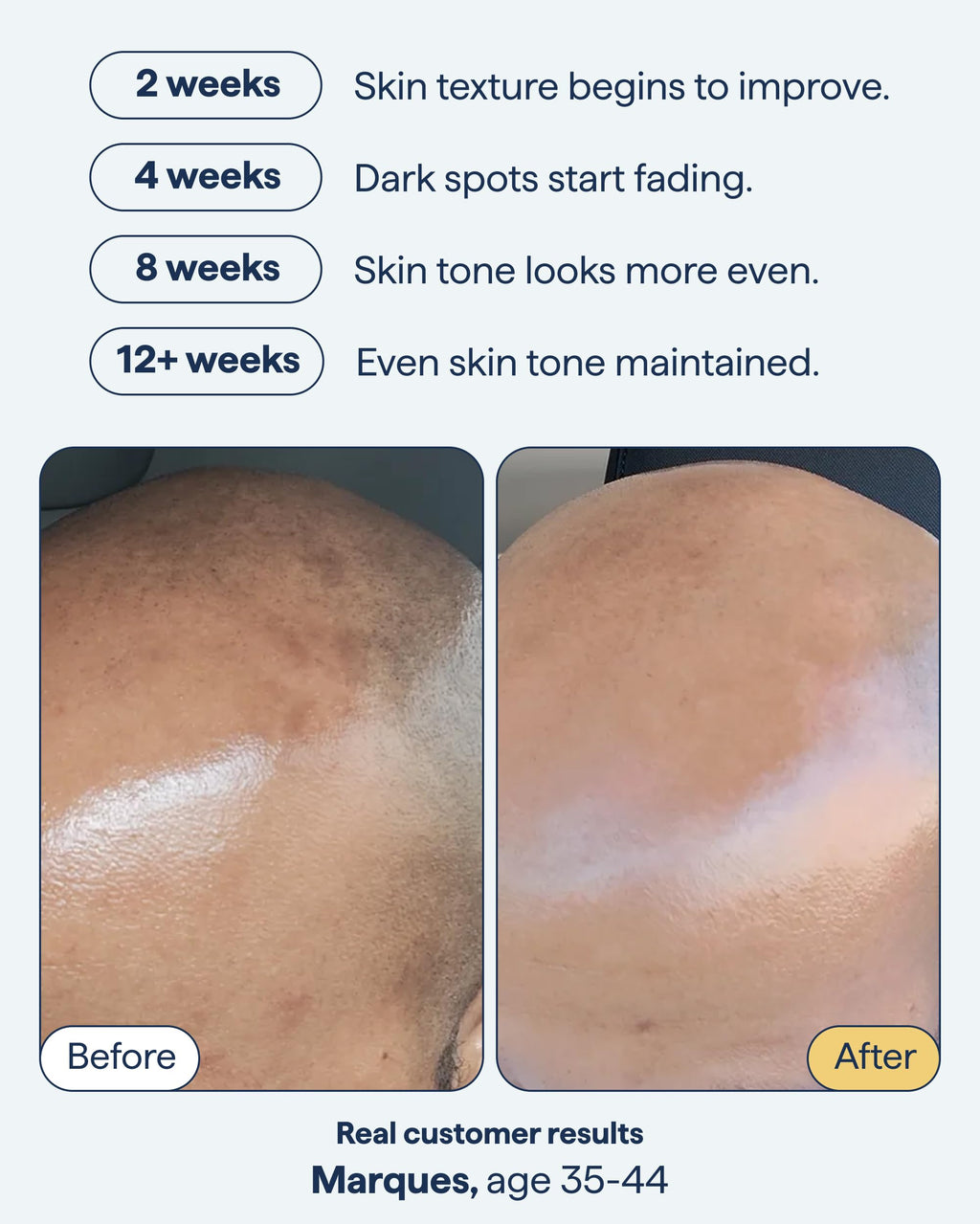 Remedy for Dark Spots | Advanced Night Treatment with Retinol & Kojic Acid | For Discoloration and Uneven Tones | With Glutathione