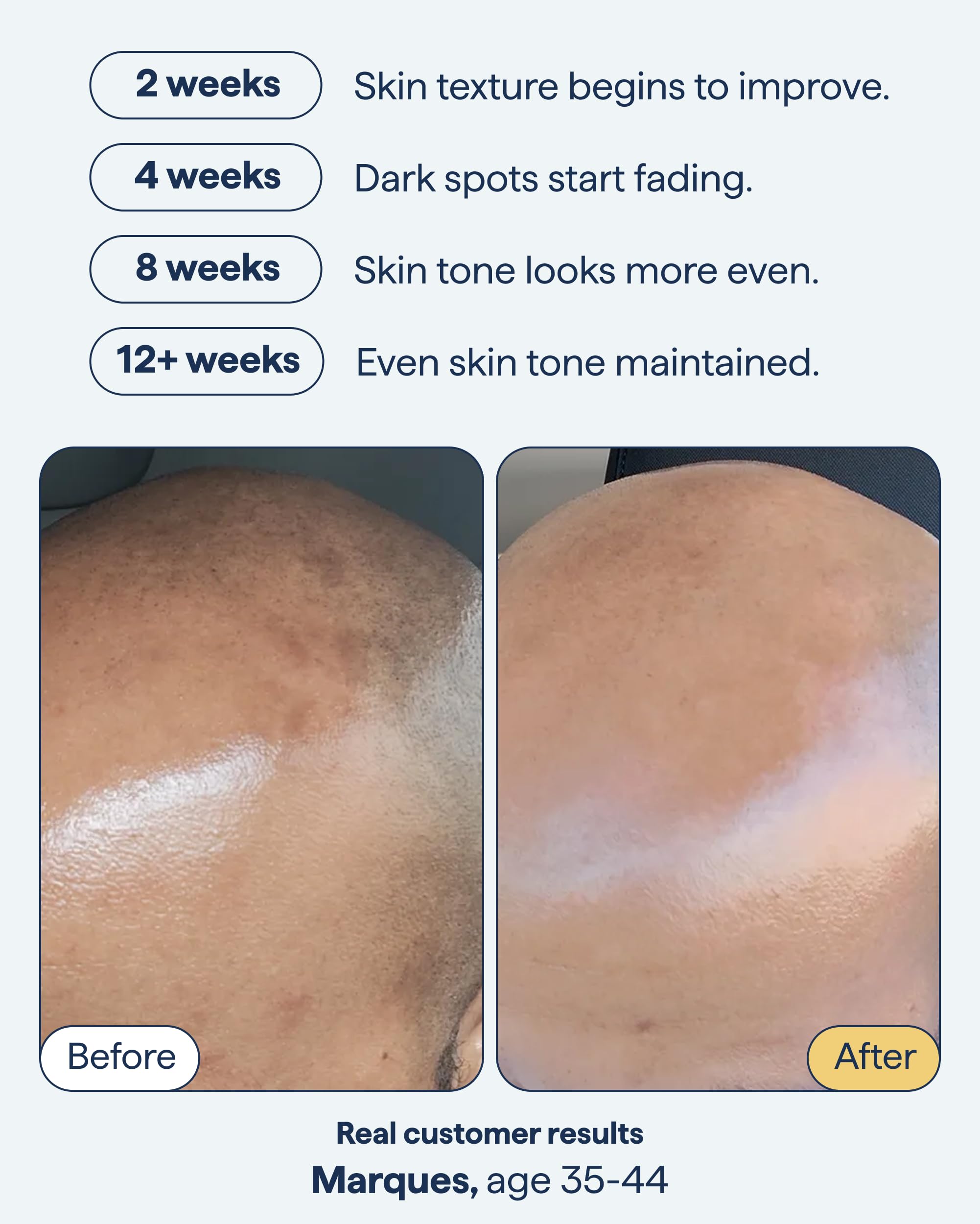 Remedy for Dark Spots | Advanced Night Treatment with Retinol & Kojic Acid | For Discoloration and Uneven Tones | With Glutathione