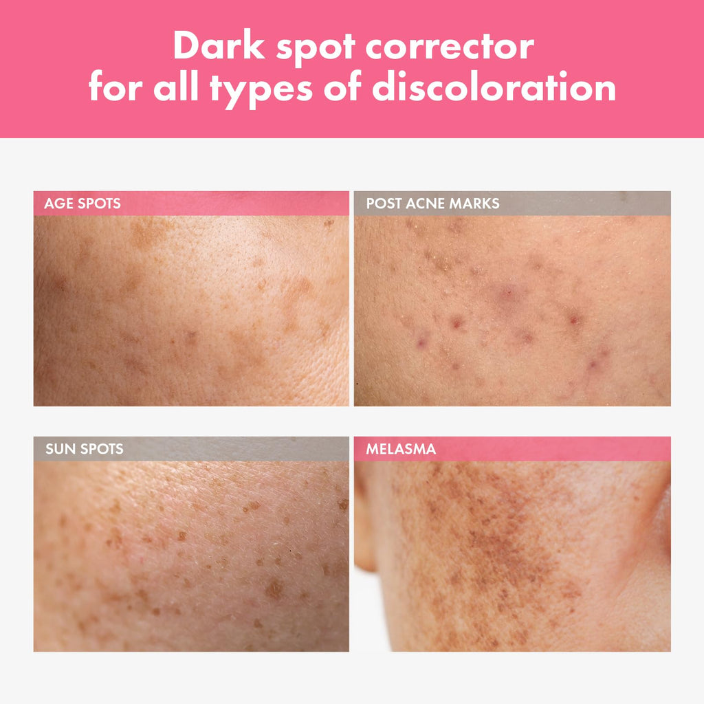 TOSOWOONG Arbutin 7% Intensive Spot Cream with 70,000ppm Arbutin, 3% Tranexamic Acid, 1% Niacinamide, Glutathione, Dark Spots