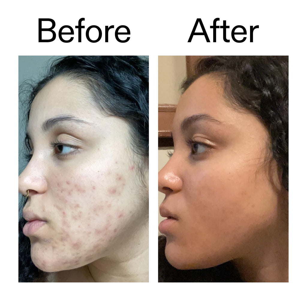 The INKEY List Tranexamic Acid Serum, Helps Reduce Appearance of Skin Discoloration