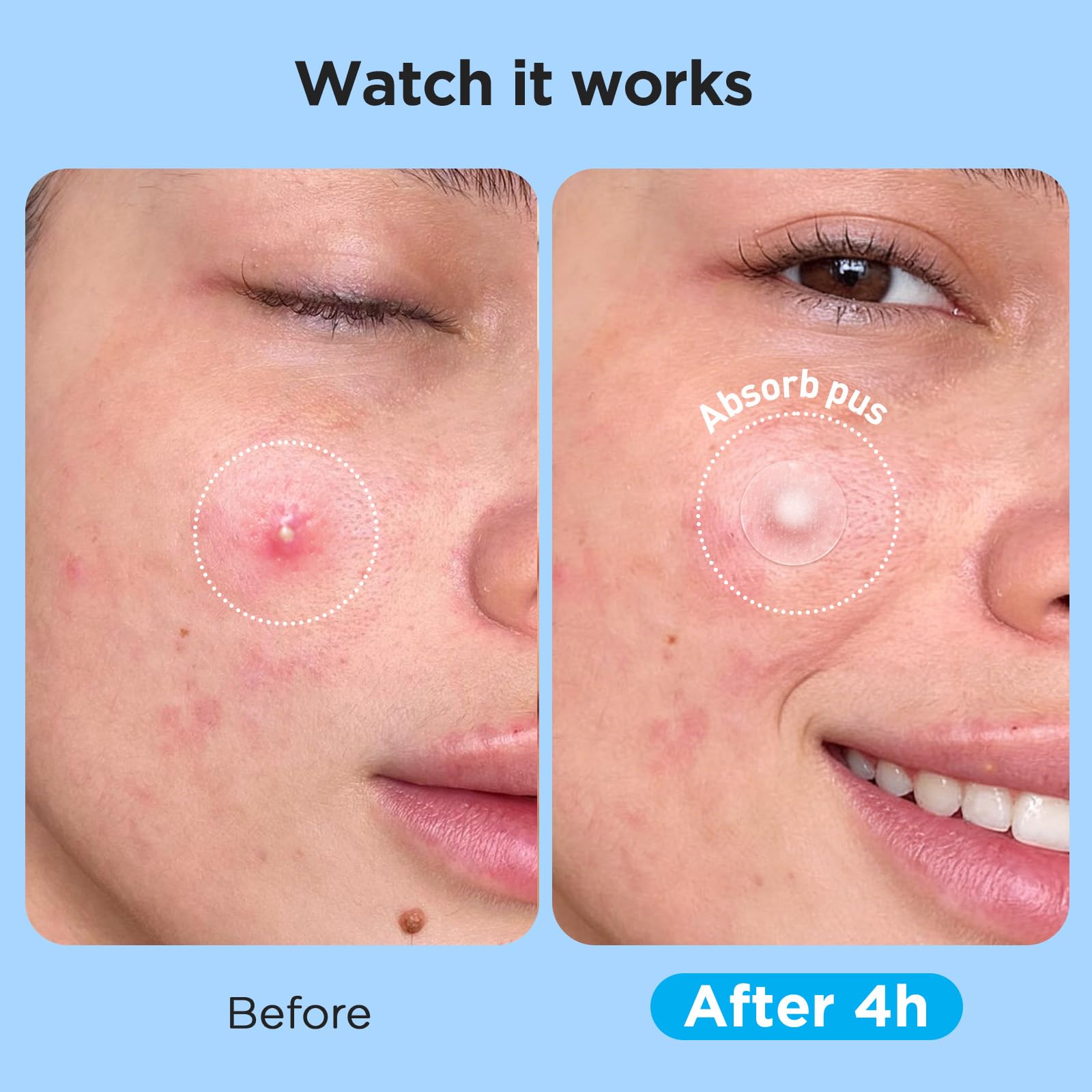 Glowpatch Pimple Patches for Face (504 Count), FSA Eligible Acne Patch Bulk, Zit Stickers 4 Sizes, Hydrocolloid Spot Stickers