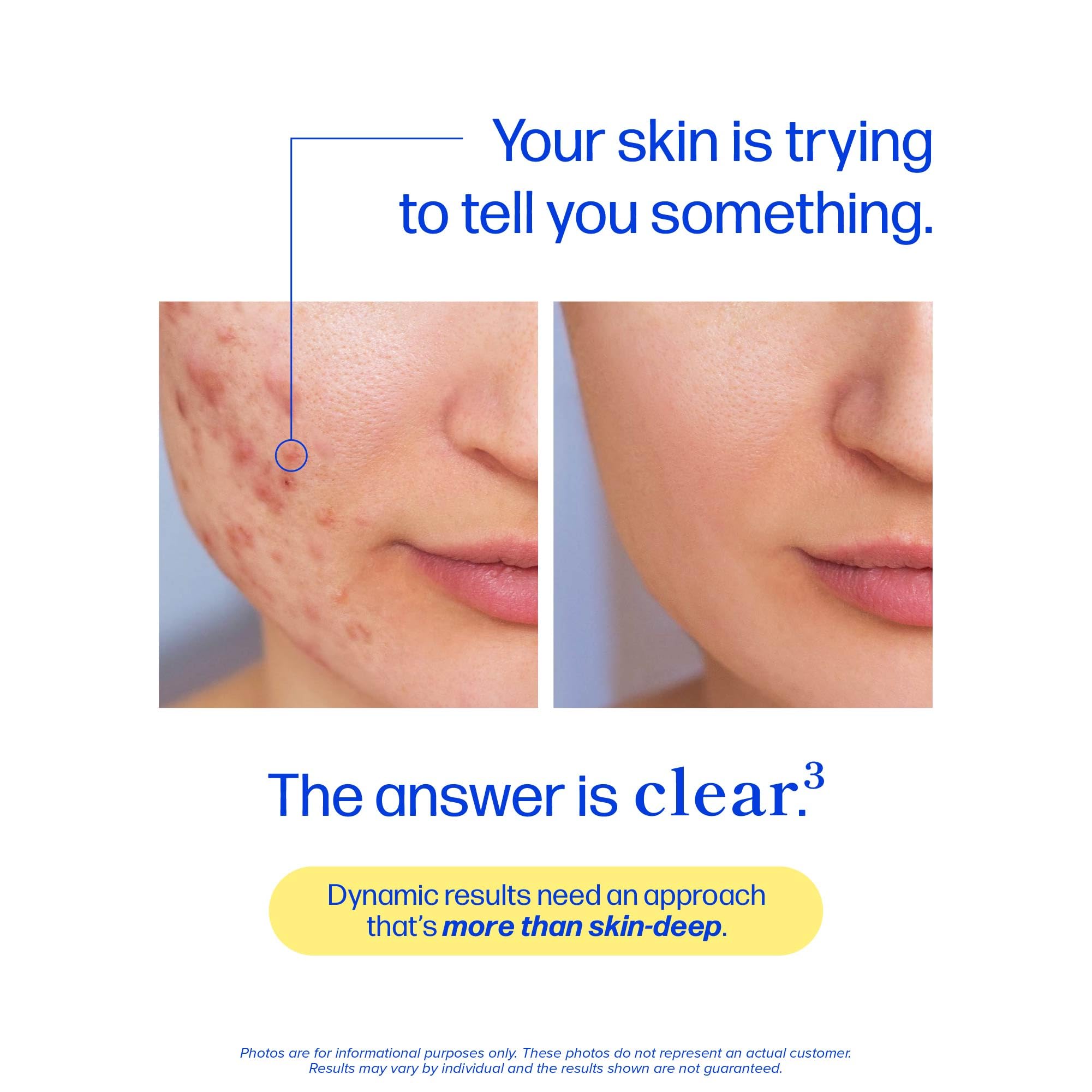 Clear Skin Supplement with Zinc, DIM & Probiotics | 3-in-1 Balance, Glow & Health Skin Support | Triple Action Hyaluronic Acid, Niaciminide & Vitamins for Hormone