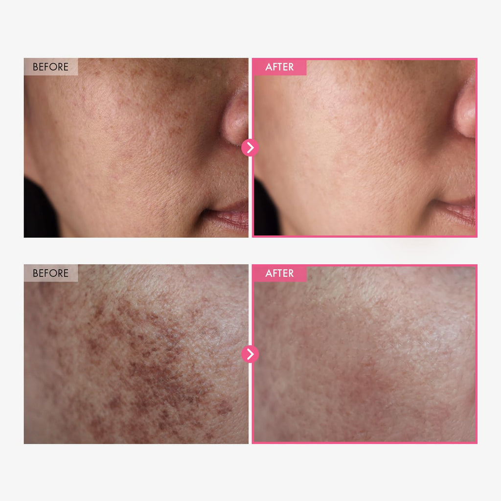 TOSOWOONG Arbutin 7% + Tranexamic Acid 4% Cream, 70,000ppm Arbutin, 40,000ppm TXA, Niacinamide, Glutathione