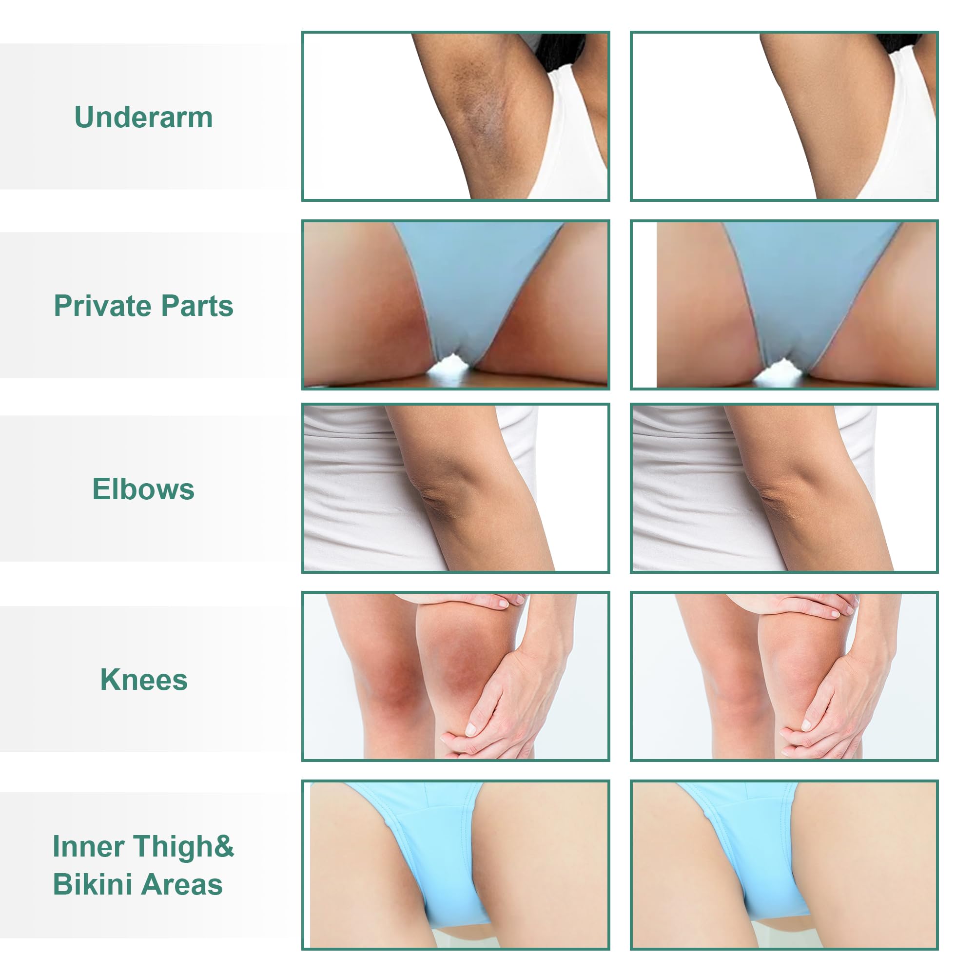 Vcetree Skin Bleaching Cream Skin Lightening for Body Intimate Areas, Private Parts, Underarm, Knees, Elbows, Inner Thigh, Bikini Area