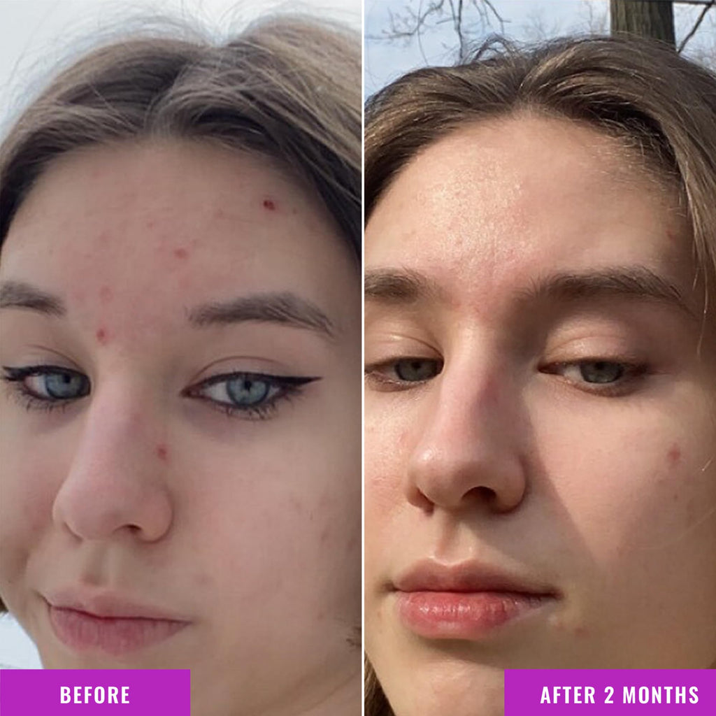 Good Molecules Niacinamide Serum - 10% Niacinamide to Target Blemishes, Nourishment