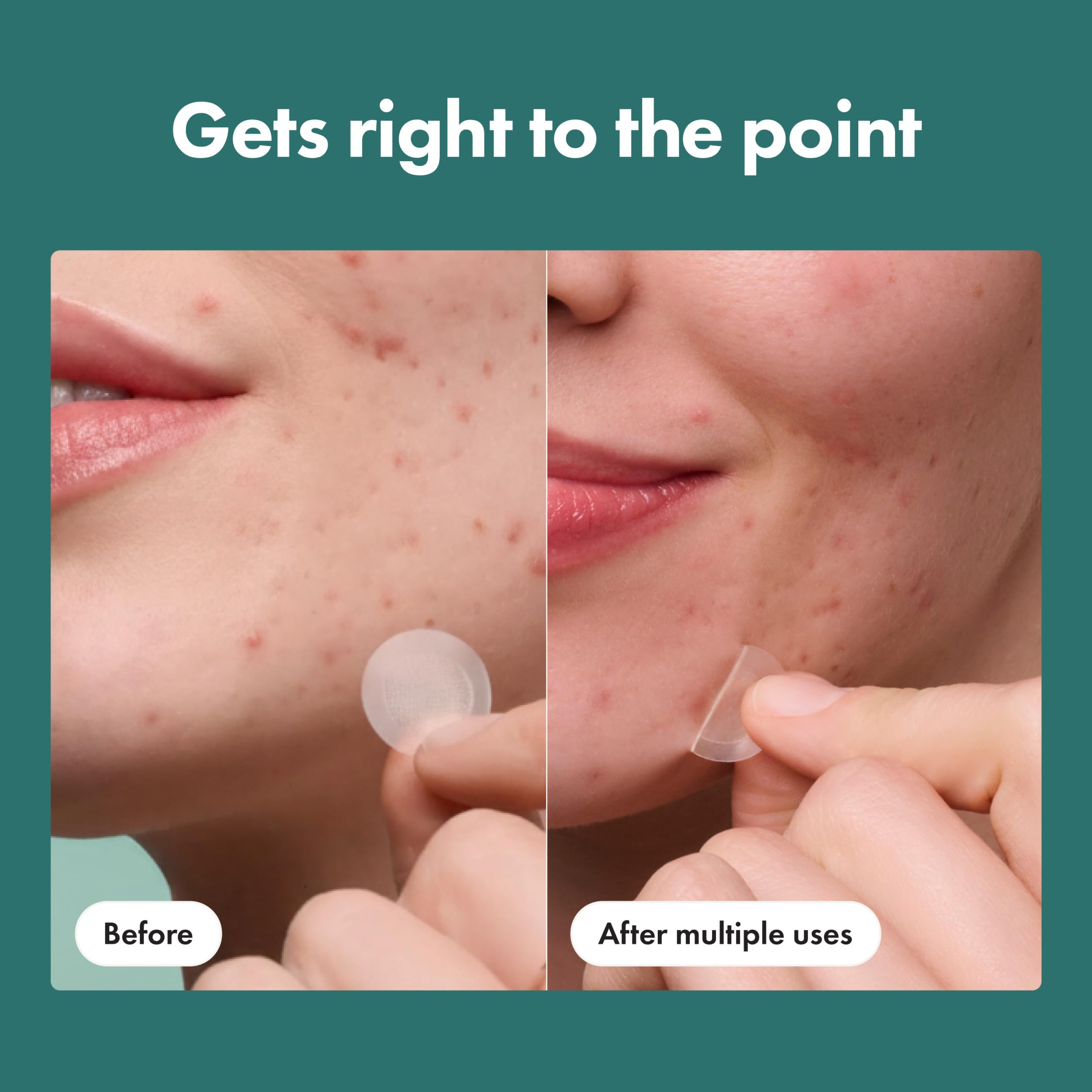 Mighty Patch Micropoint Large Hydrocolloid Pimple Patches for Face Blemishes from Hero Cosmetics, Acne Stickers for Early Stage Zits