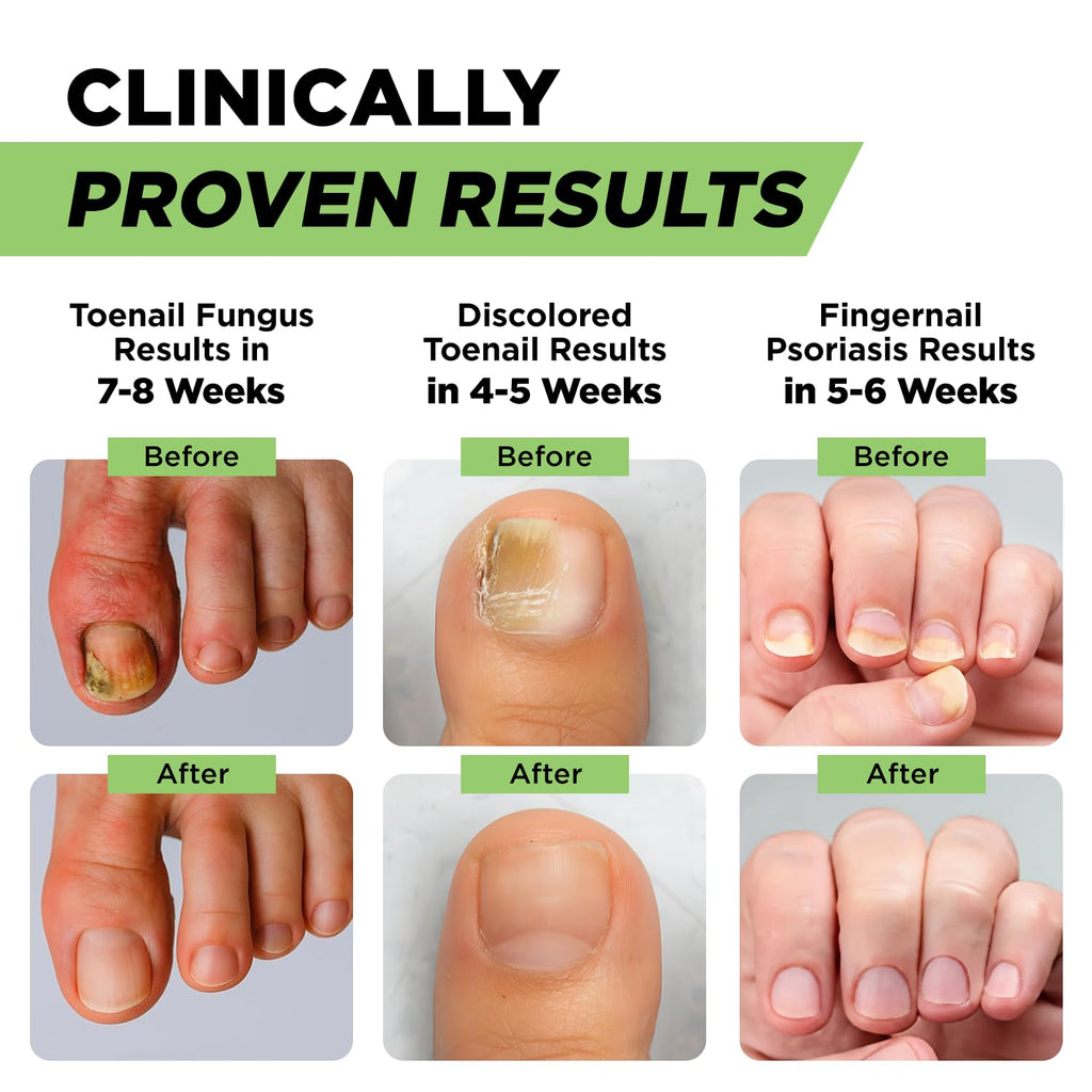Footcure Antifungal Nail Treatment Pen – Extra Strength Toenail Fungus Treatment
