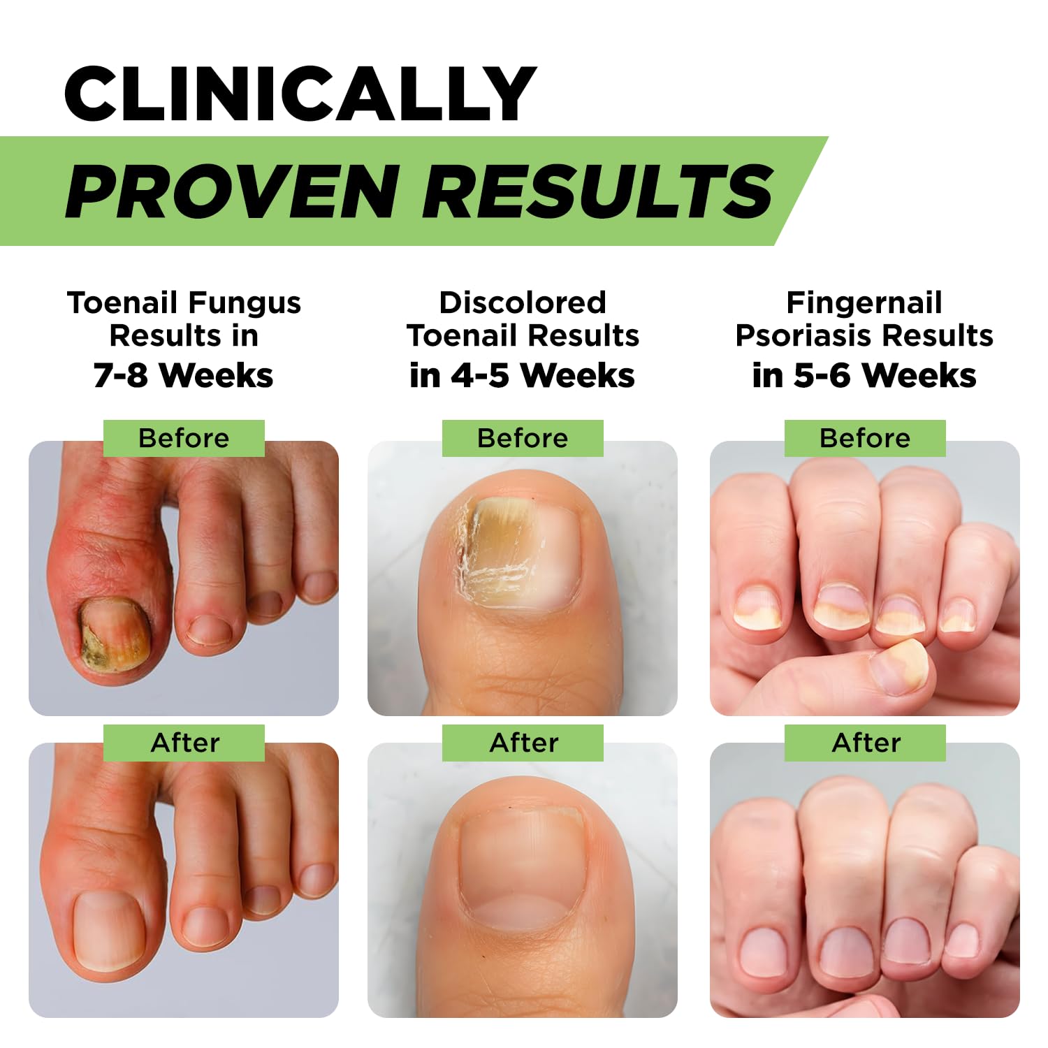 Footcure Antifungal Nail Treatment Pen – Extra Strength Toenail Fungus Treatment