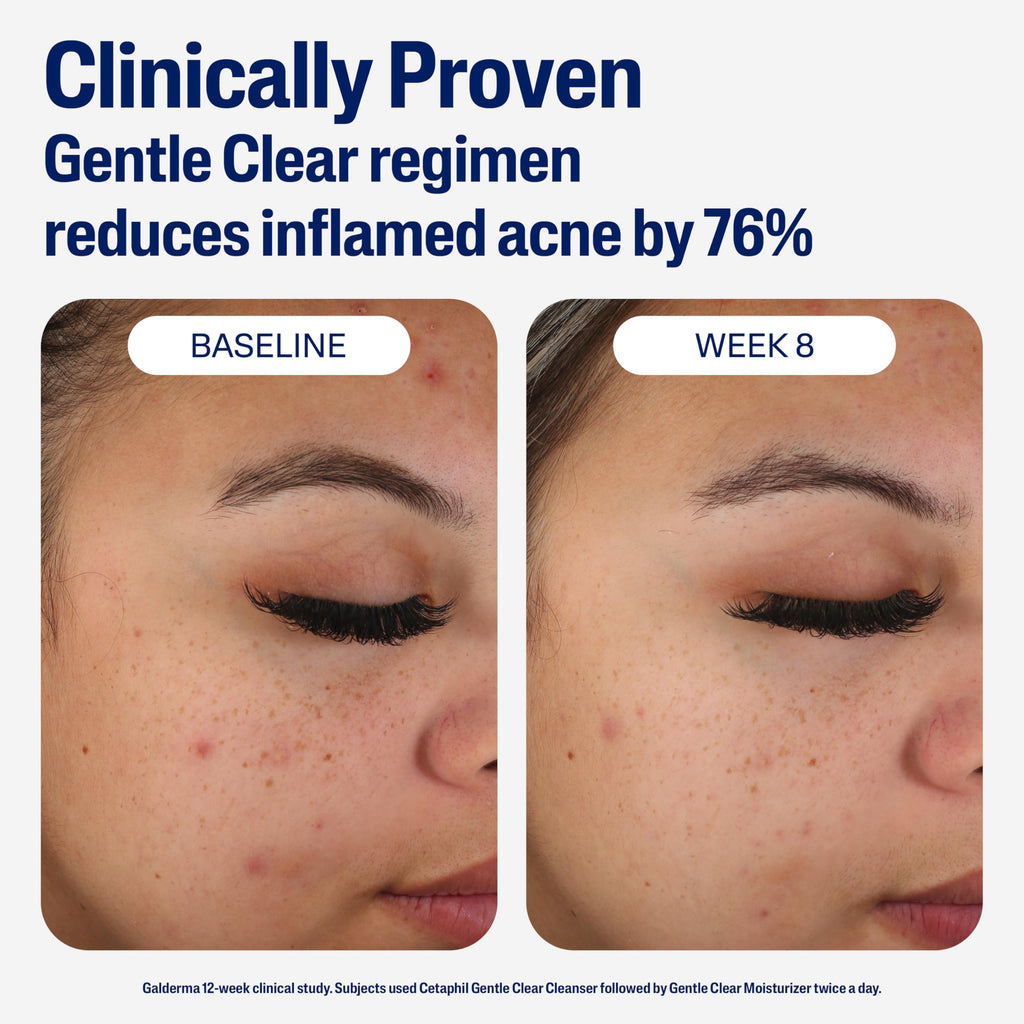 Cetaphil Face Moisturizer, Gentle Clear Mattifying Acne Moisturizer With 0.5% Salicylic Acid