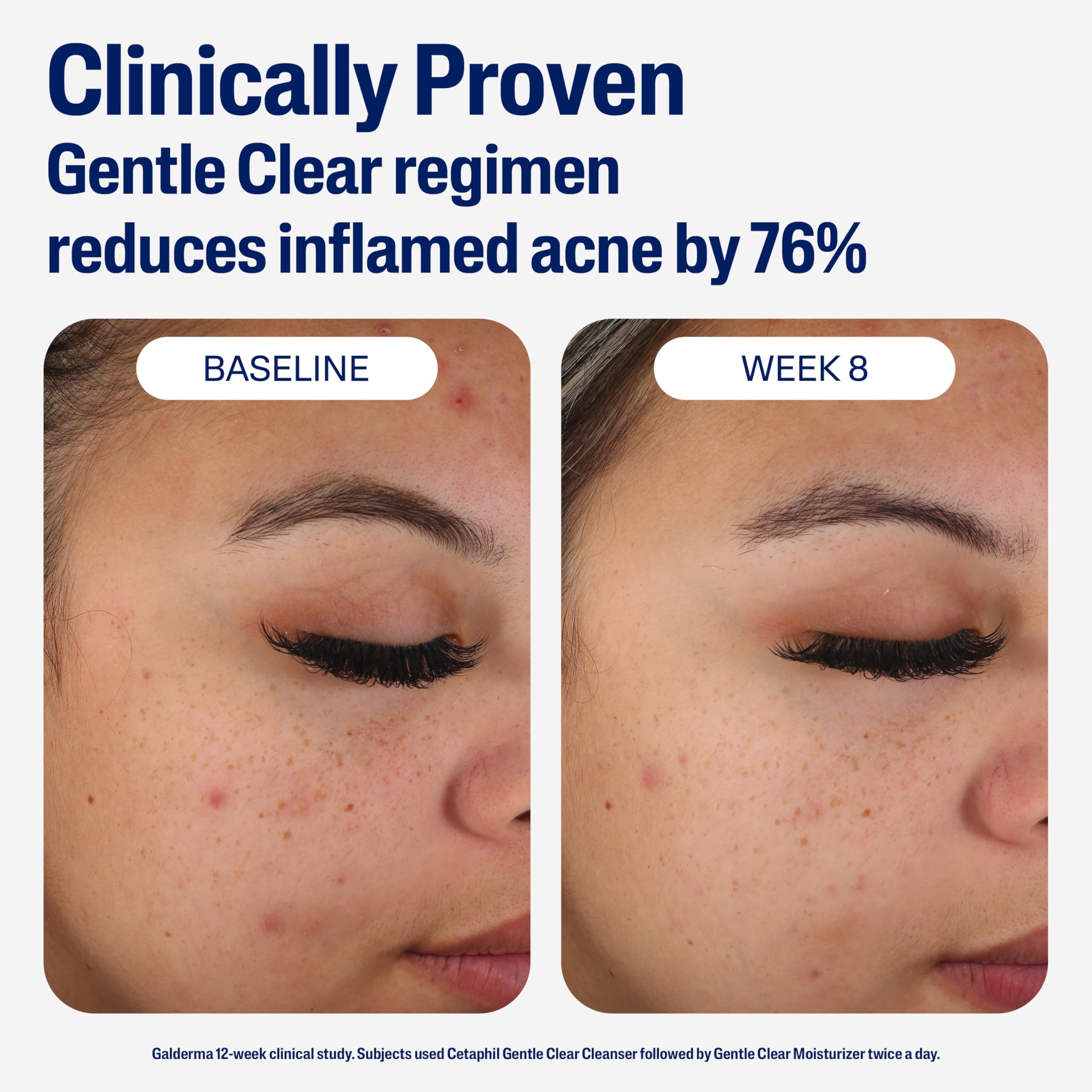 Cetaphil Face Moisturizer, Gentle Clear Mattifying Acne Moisturizer With 0.5% Salicylic Acid