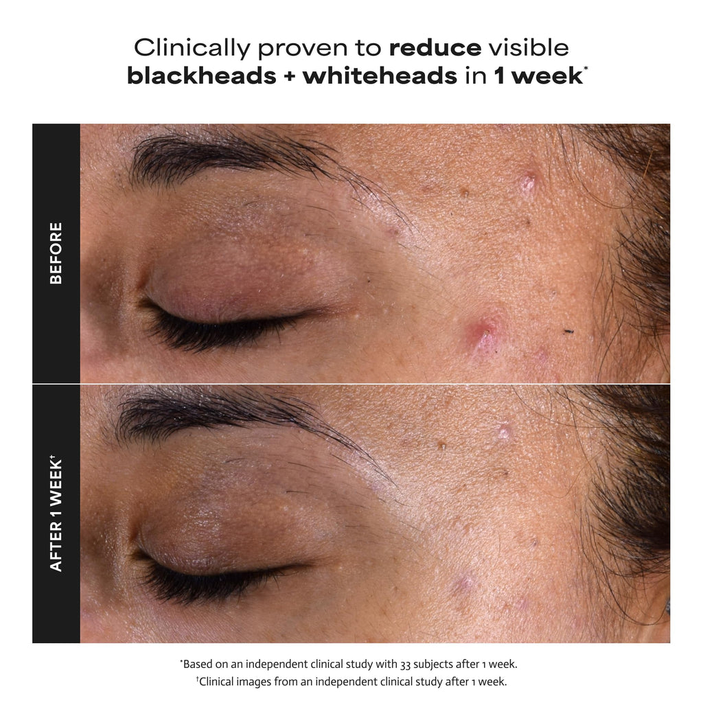 Paulas Choice--SKIN PERFECTING 2% BHA Liquid Salicylic Acid Exfoliant--Facial Exfoliant for Blackheads, Enlarged Pores, Wrinkles & Fine Lines, 4 oz Bottle Paula's Choice Au supplements