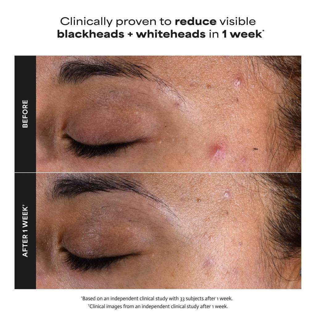 Paulas Choice--SKIN PERFECTING 2% BHA Liquid Salicylic Acid Exfoliant--Facial Exfoliant Paula's Choice Au supplements
