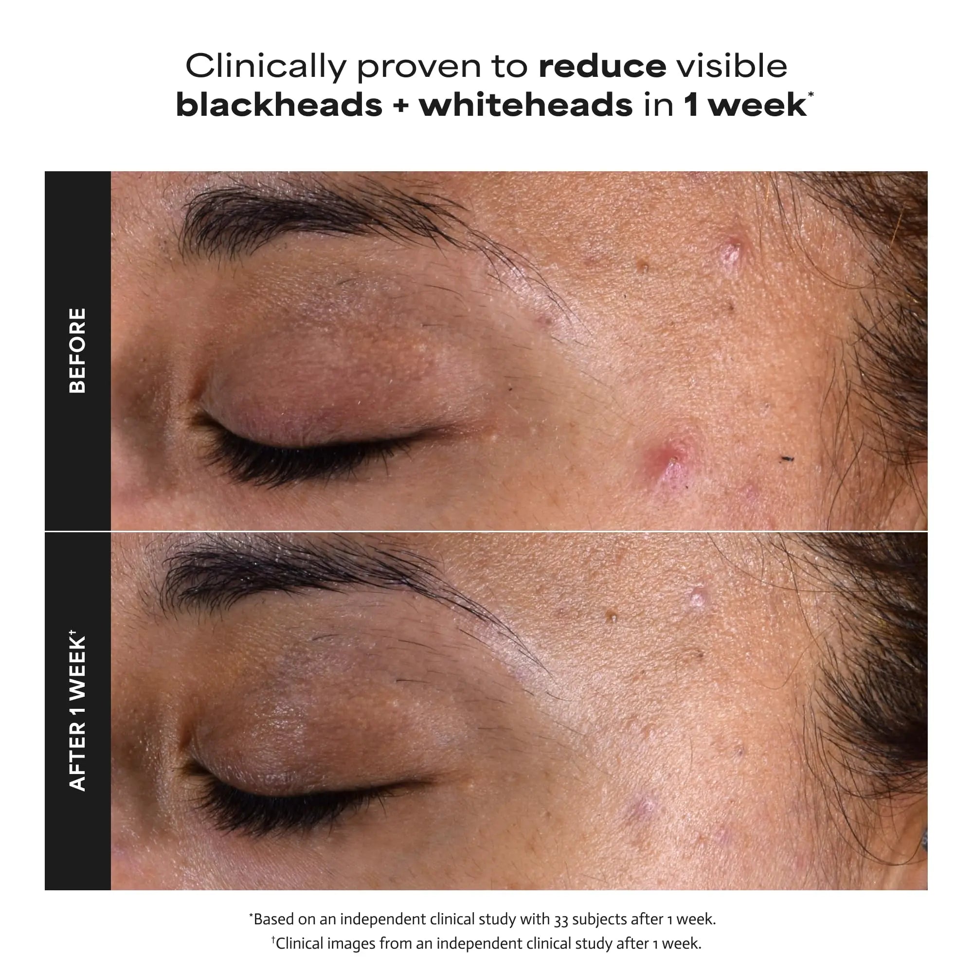 Paulas Choice--SKIN PERFECTING 2% BHA Liquid Salicylic Acid Exfoliant--Facial Exfoliant Paula's Choice Au supplements