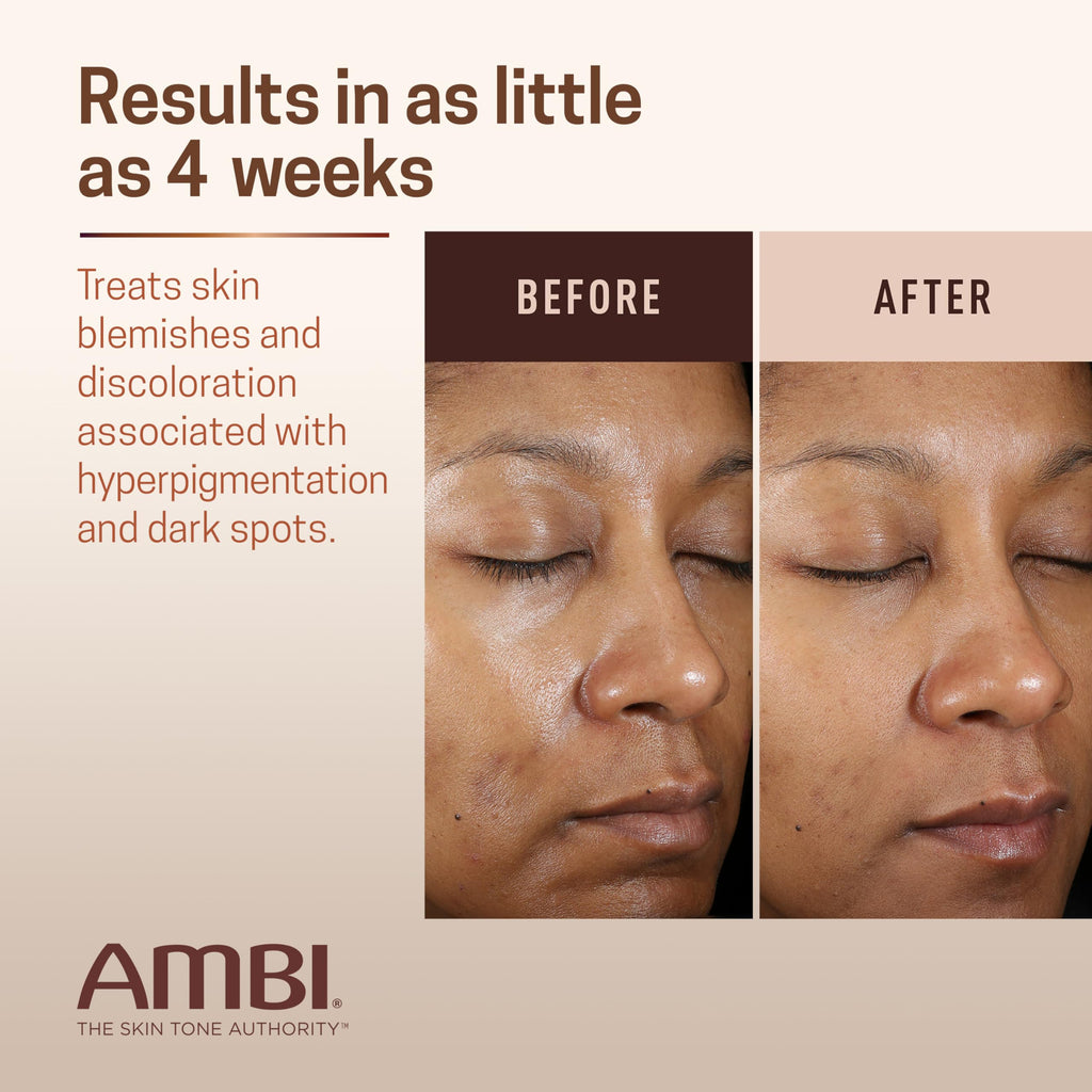 Ambi Even & Clear Advanced Fade Cream, Hydroquinone-free, Hyperpigmentation Treatment, Stubborn Dark Spot Corrector, Results In As Little As 2-3 Weeks
