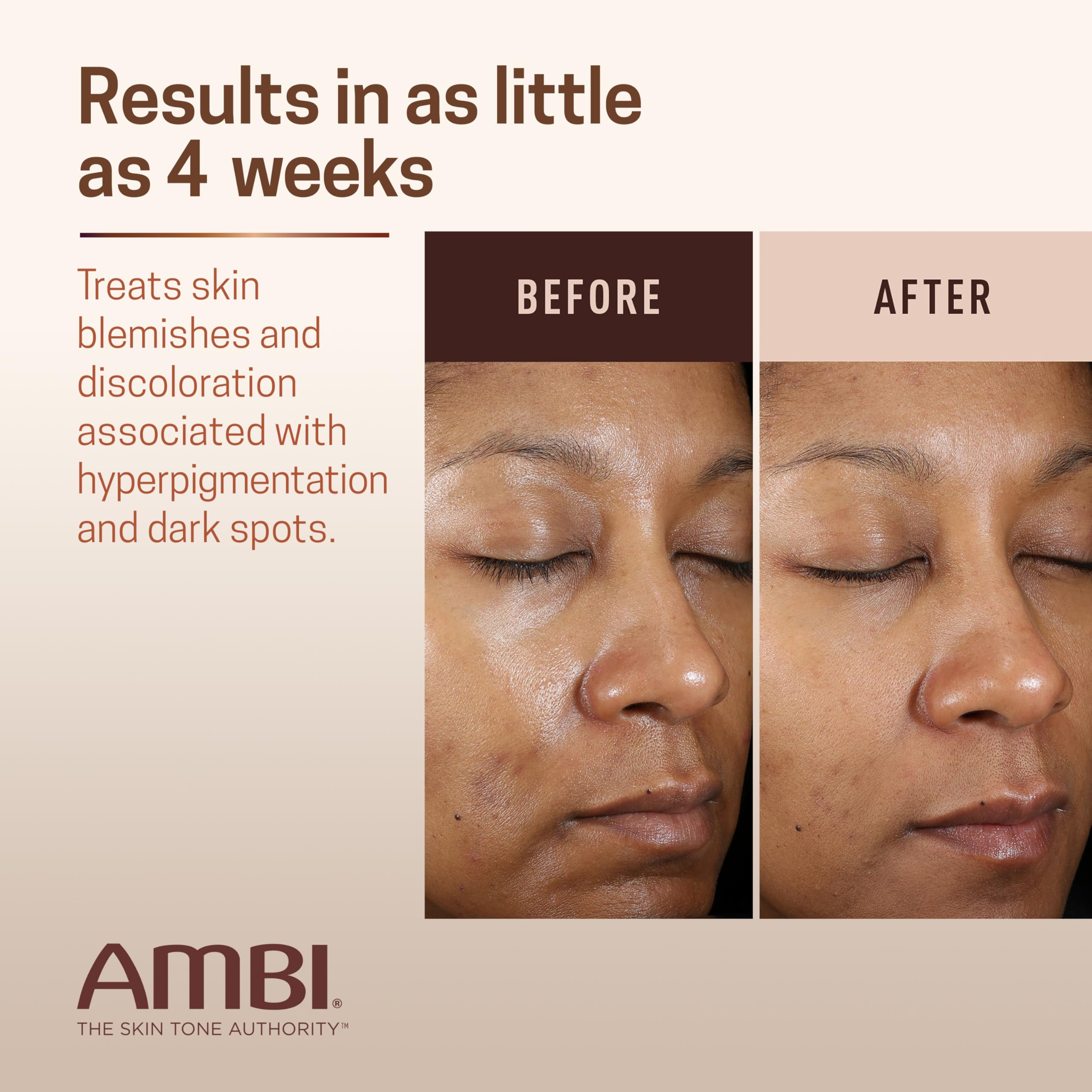 Ambi Even & Clear Advanced Fade Cream, Hydroquinone-free, Hyperpigmentation Treatment, Stubborn Dark Spot Corrector, Results In As Little As 2-3 Weeks