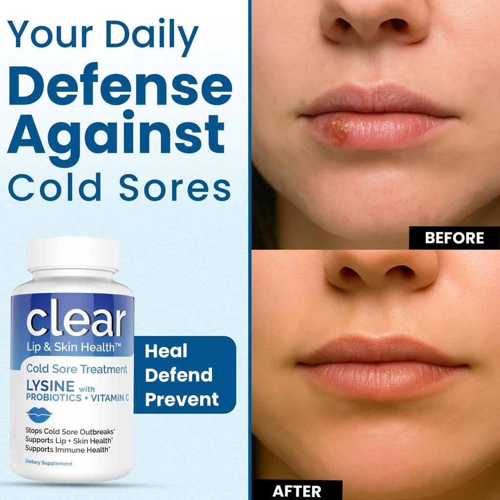 Lysine Cold Sore Treatment for Lips with Pre-Probiotics & VIT C | 1 Month Supply | Supercharged Lysine Capsules with Rhamnosus & Acidophilus for Cold Sores Relief
