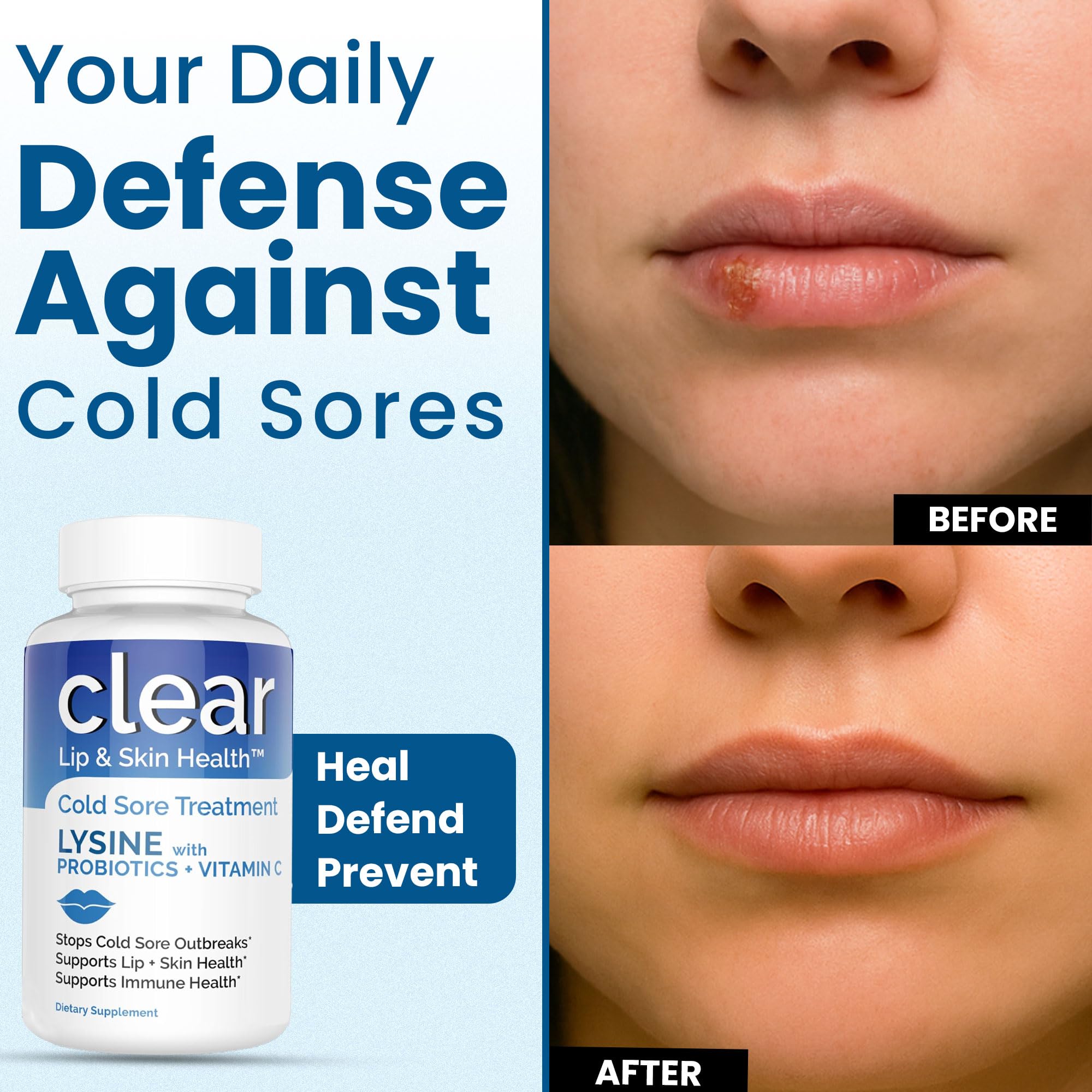Lysine Cold Sore Treatment for Lips with Pre-Probiotics & VIT C | 1 Month Supply | Supercharged Lysine Capsules with Rhamnosus & Acidophilus for Cold Sores Relief