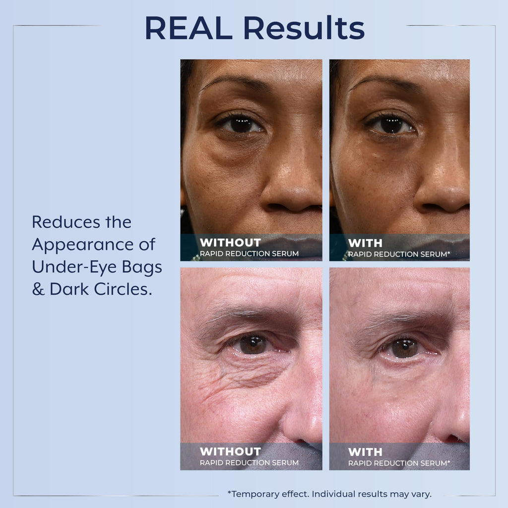 Plexaderm Rapid Reduction Eye Serum - Visibly Reduces Under-Eye Bags, Wrinkles, Dark Circles, Fine Lines & Crow's Feet Instantly