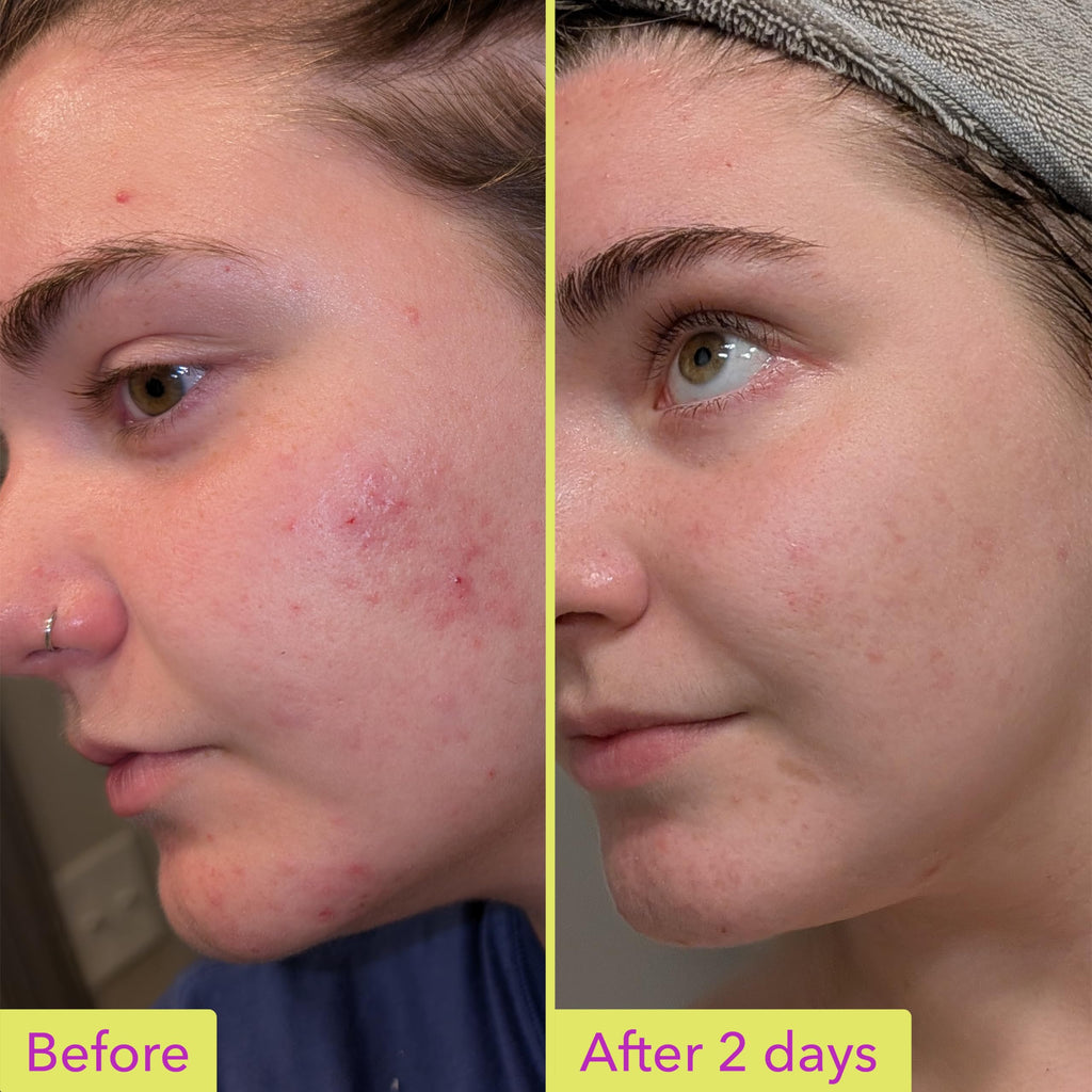 Good Molecules 10% Azelaic Acid Treatment for Face – Soothing Formula for Facial Redness