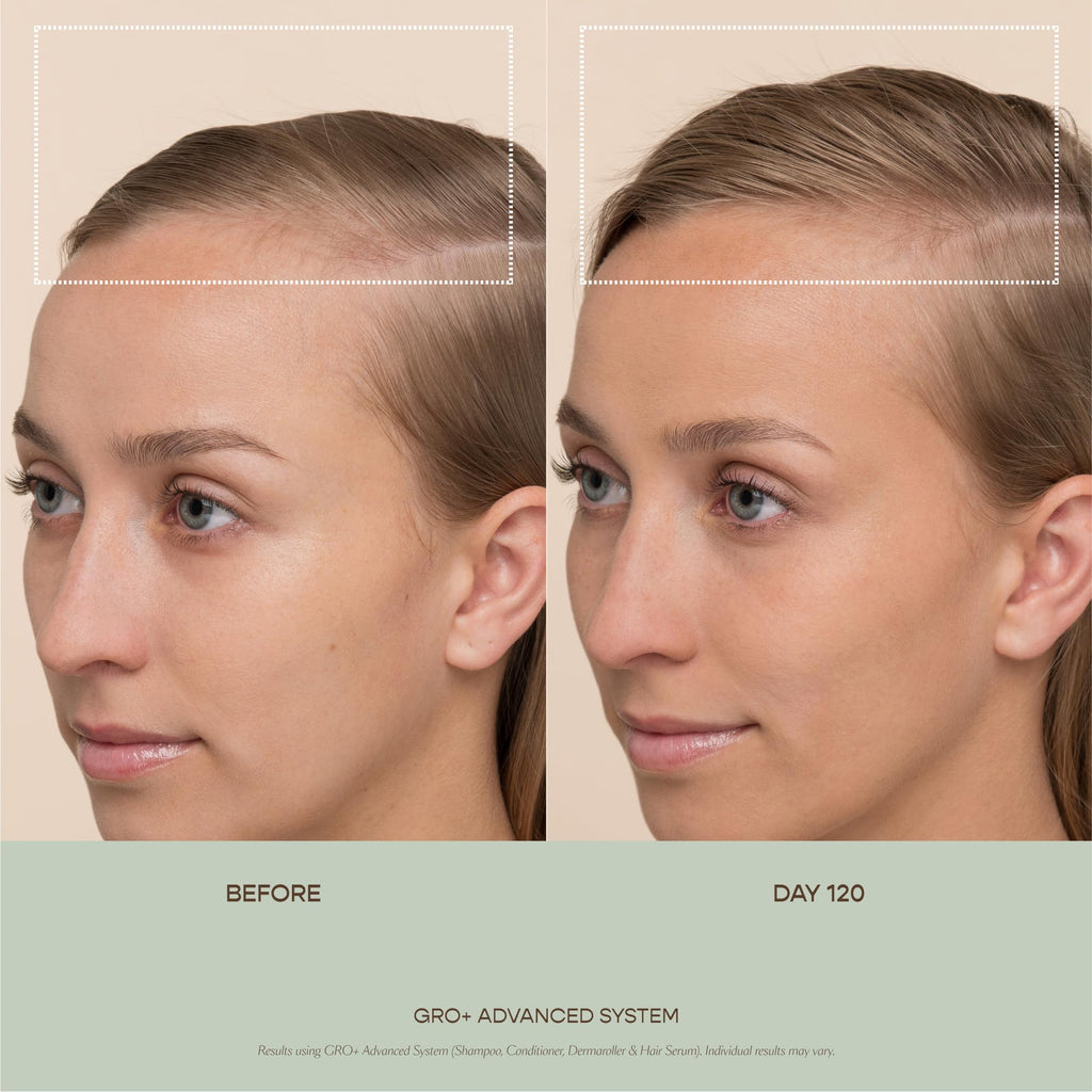 VEGAMOUR GRO+ Advanced Dermaroller | 1,200 Microneedle 0.25mm Scalp Tool | Gently Exfoliates the Scalp | Wide Head for Maximum Coverage VEGAMOUR Au supplements