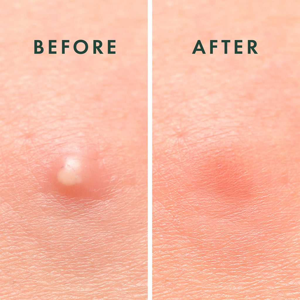 Rael Pimple Patches, Miracle Invisible Spot Cover - Hydrocolloid Acne Pimple Patch